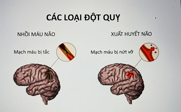 Các loại đột quỵ
